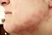 Côté gauche d'un visage de piqûres de punaises de lit, provoquant marques de points rouges sur une grande surface de dessous du lobe de l'oreille au menton.