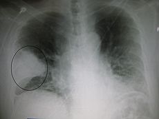 Un X-ray: montrant un coin blanc dans le domaine du poumon droit d'une radiographie pulmonaire.