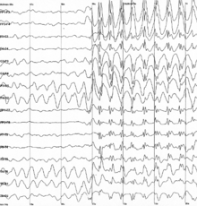 Gráfico mostrando 16 traços de tensão que vão através da página da esquerda para a direita, cada um mostrando um sinal diferente. No meio da página todos os traços começam abruptamente para mostrar picos afiados espasmódicos, que continuam até o fim da trama.